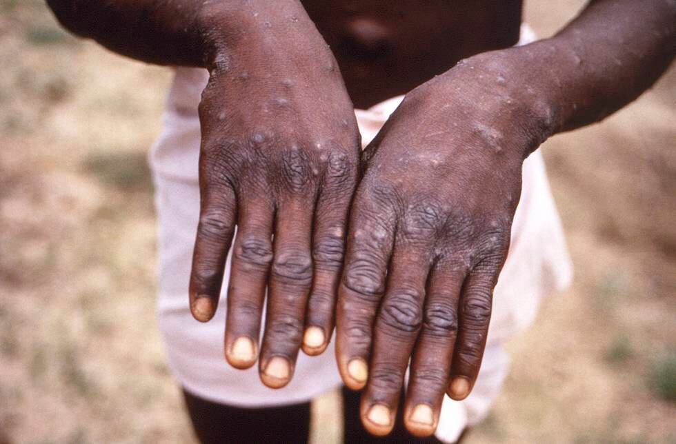 En kongolesisk mann viser fram hendene sine etter å ha blitt smittet av apekopper i 1997. I Afrika har det vært jevnlige utbrudd av sykdommen i flere tiår, men først nå, etter noen hundre tilfeller i vestlige land, har forskningen på sykdommen skutt fart. Foto: CDC via AP / NTB