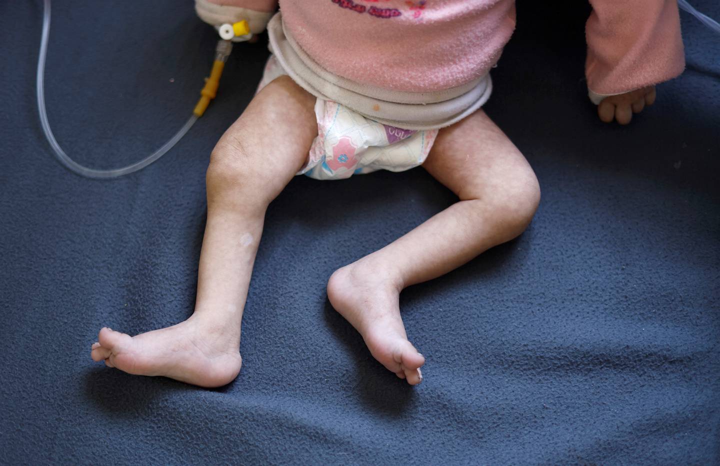 Et palestinsk barn som lider av underernøring får behandling på Al-Awda-sykehuset 1. april i år.