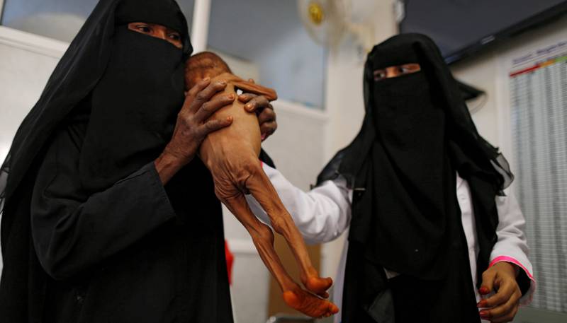 Underernæring har lenge vært et problem i Jemen, men er blitt verre med krigen. Her er en mor med sin      lille underernærte sønn på en intensivavdeling i byen Houdeidah i Jemen. 