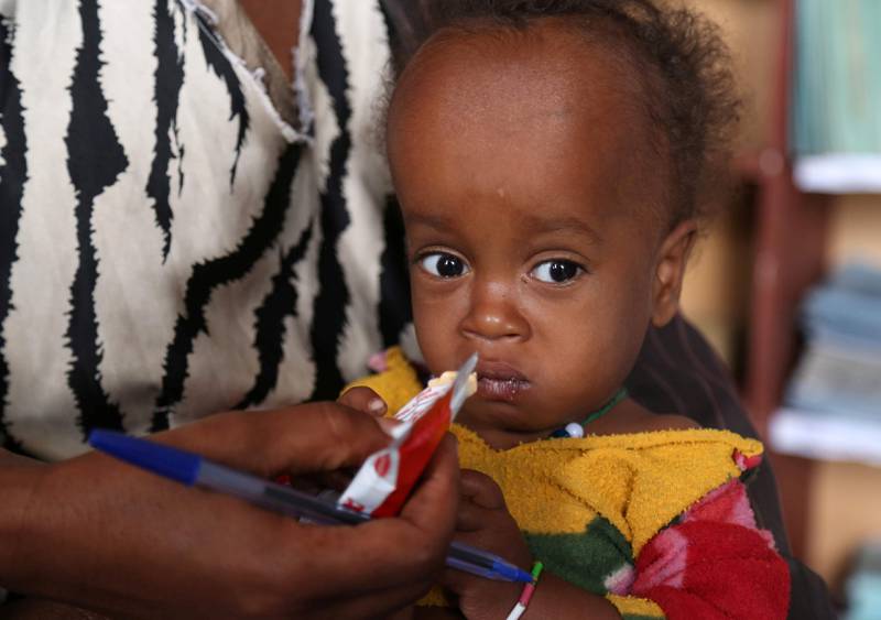 AKUTT UNDERERNÆRT: En 14 måneder gammel gutt i Etiopia som er akutt underernært får ernæringshjelp ved Halo helsestasjon i Oromia-regionen. FOTO: NTB SCANPIX