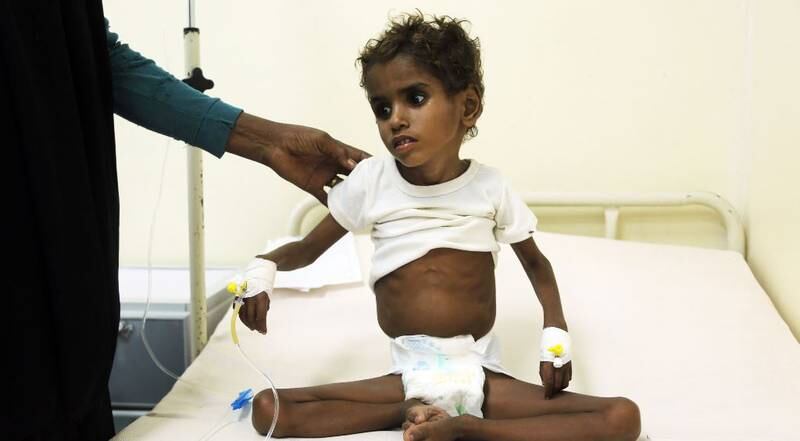 Et underernært barn mottar behandling på et sykehus i havnebyen Hodeidah tidligere denne uka. Blokaden som ble innført denne uka forverrer en allerede kritisk situasjon.