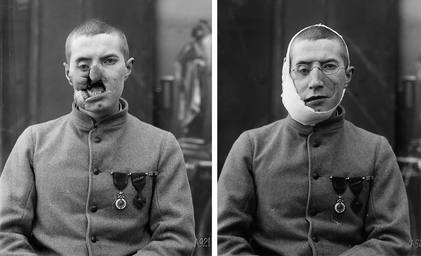 Før og etter-bilde av en av soldatene som fikk ansiktsmaske. Foto: Library of Congress.