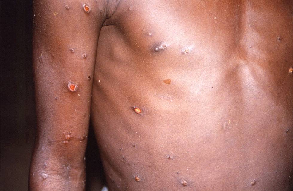 Apekopper er svært uvanlig, men er påvist i utbrudd i flere land i Europa nå. Bildet viser en person som var smittet av apekopper under et utbrudd i Den demokratiske republikken Kongo i 1996/1997.