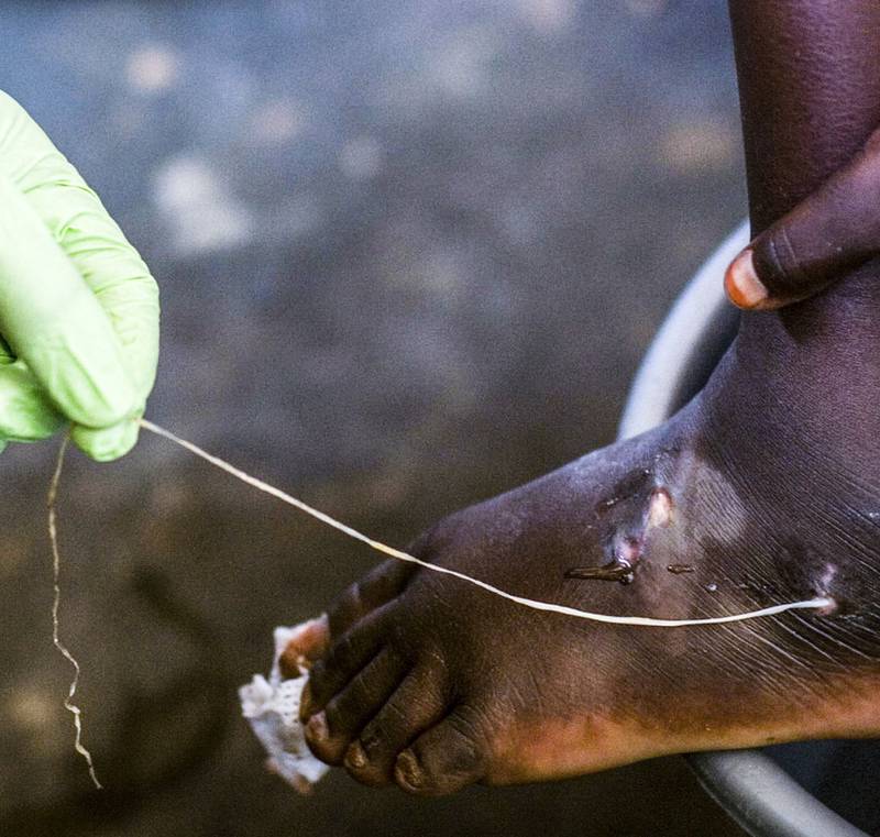 En guineaorm trekkes ut fra en barnefot i Ghana i 2007. Ormen kan bli en meter lang inni kroppen. 
