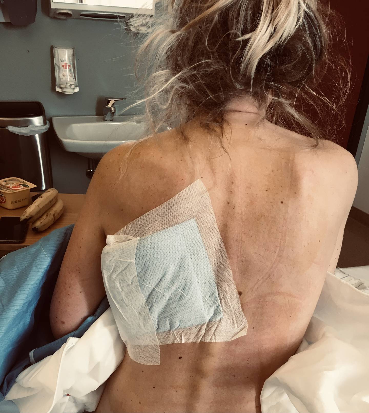 OPERASJON: Silje Løkeng var gjennom flere mislykkede forsøk på rekonstruere brystet. Blant annet ble det forsøkt å transplantere hud fra ryggen. 
Foto: Privat