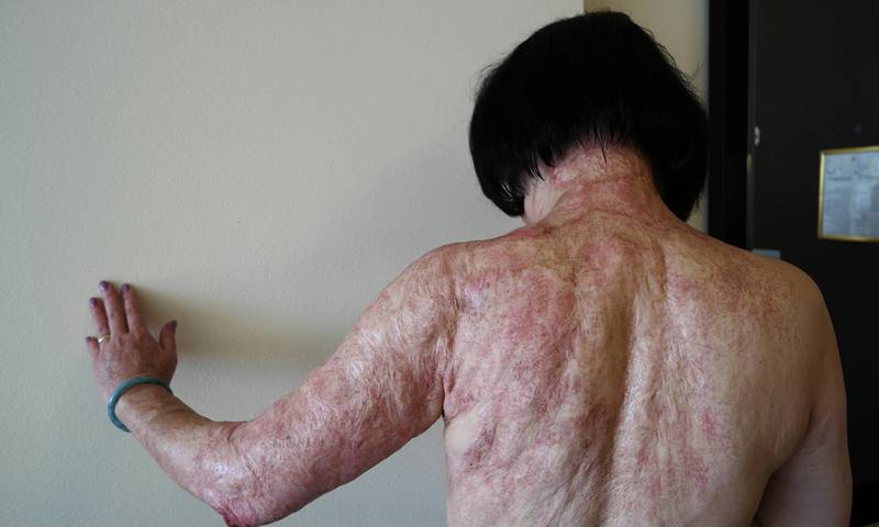 Kim Phuc har store skader etter napalm-angrepet som rammet landsbyen hennes da hun var ni år. Siden i fjor har hun gjennomgått arr-oppmykende laserbehandling.