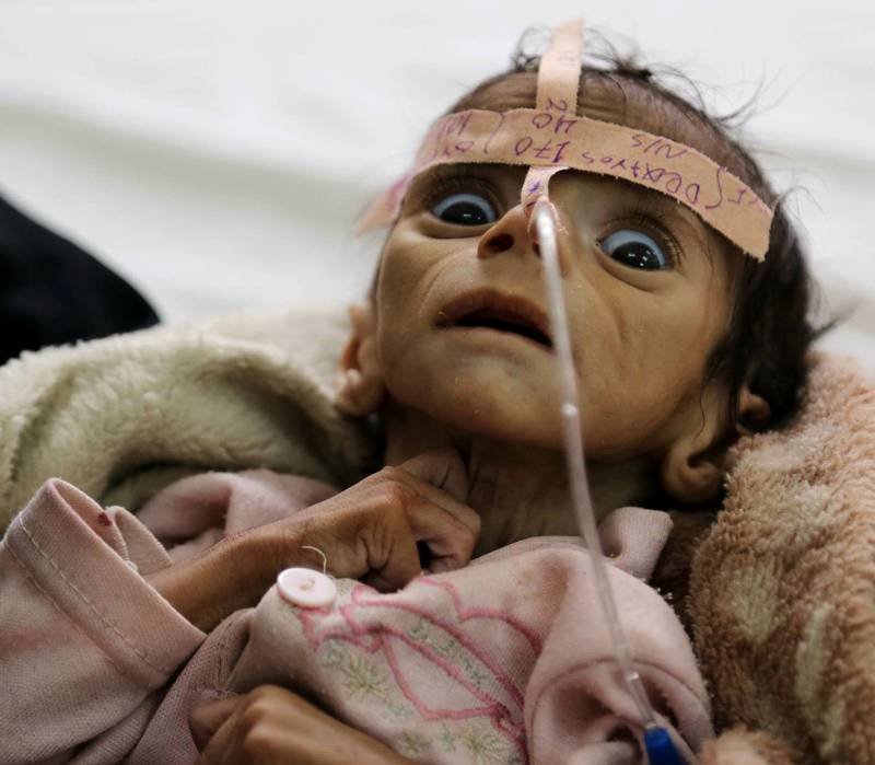 Lille Udai Faisal ble et symbol på hungersnøden i Jemen da han døde av underernæring to dager etter at dette bildet ble tatt i mars i fjor. Ett år etter er situasjonen enda verre.