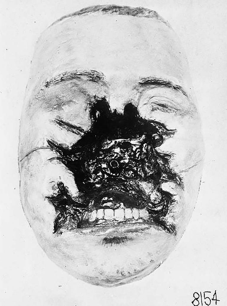Avstøpning av et lemlestet ansikt. En slik avstøpning kunne være svært smertefull, men var nødvendig for å kunne bygge opp en passende maske. Foto: Library of Congress
