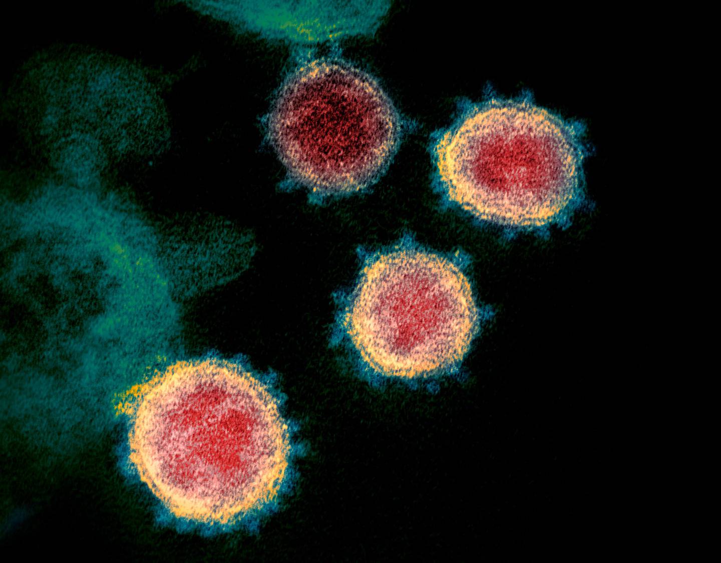 This undated electron microscope image made available by the U.S. National Institutes of Health in February 2020 shows the virus that causes COVID-19. The sample was isolated from a patient in the U.S. (NIAID-RML via AP)