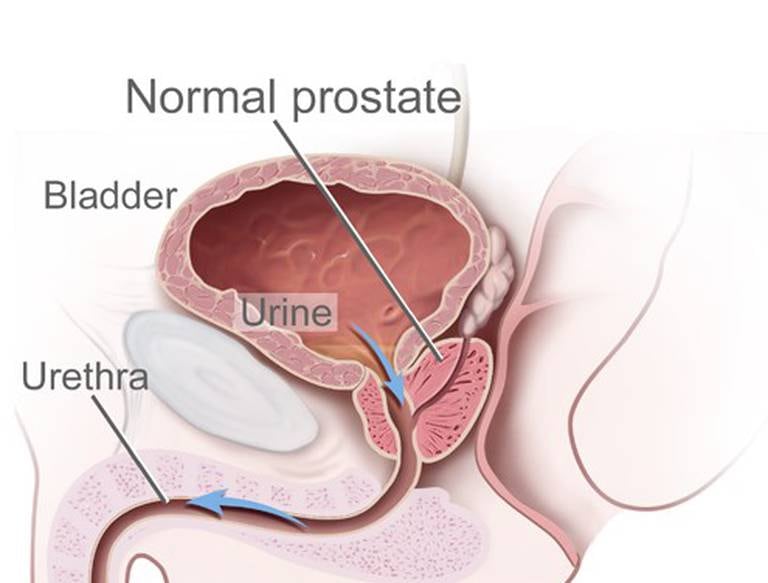 Prostatitt betyr at prostatakjertelen er betent, ofte forårsaket av en infeksjon. Prostatakjertelen ligger mellom blære og penis, like framfor endetarmen (rektum).